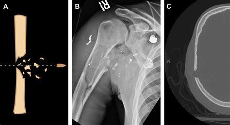 Understanding Ballistic Injuries .